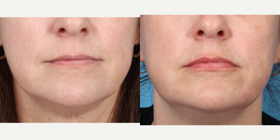 Lip Fillers before and after photo