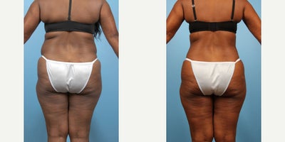 Liposuction before and after photo