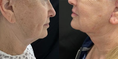 Neck Lift before and after photo