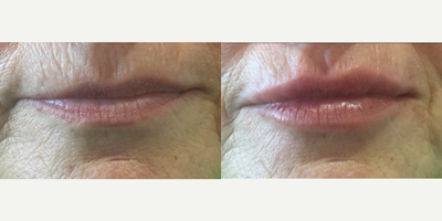 Restylane Refyne before and after photo