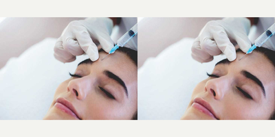 Botox before and after photo
