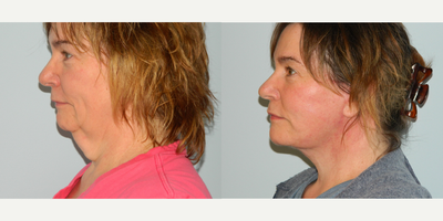 Facelift before and after photo