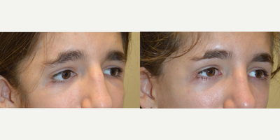 Facial Reconstructive Surgery before and after photo