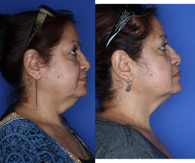 Kybella before and after photo