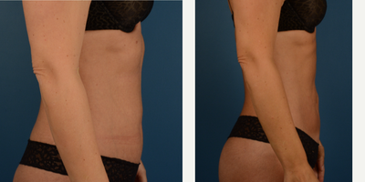 Abdominal Etching before and after photo