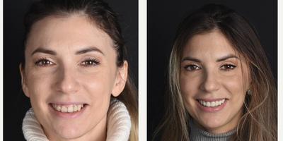 Dental Crown before and after photo
