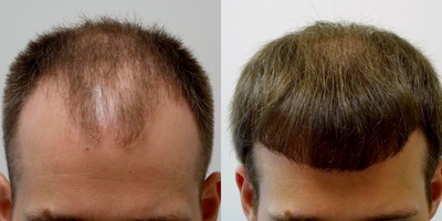 Hair Transplant before and after photo