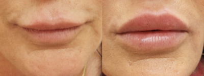 Lip Fillers before and after photo