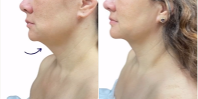 PrecisionTx before and after photo