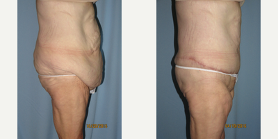 Body Lift before and after photo