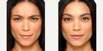 Botox before and after photo