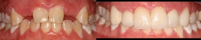 Dental Implants before and after photo