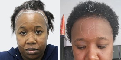 Hair Transplant before and after photo