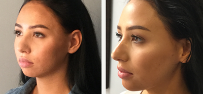 Juvederm before and after photo