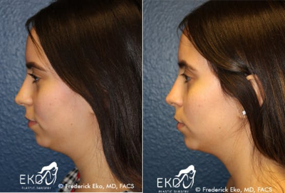 Kybella before and after photo