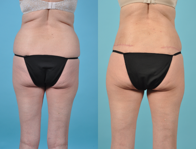 Liposuction before and after photo