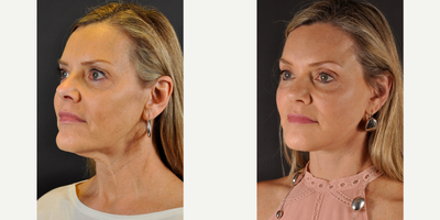 Mini Facelift before and after photo