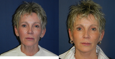 Neck Lift before and after photo