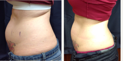 SculpSure before and after photo