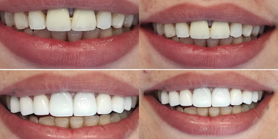 Dental Crown before and after photo