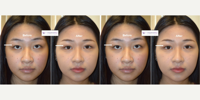 Double Eyelid Surgery before and after photo