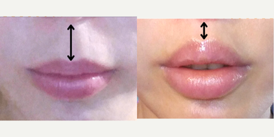 Lip Lift before and after photo