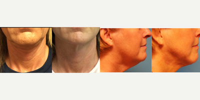 Skin Tightening before and after photo
