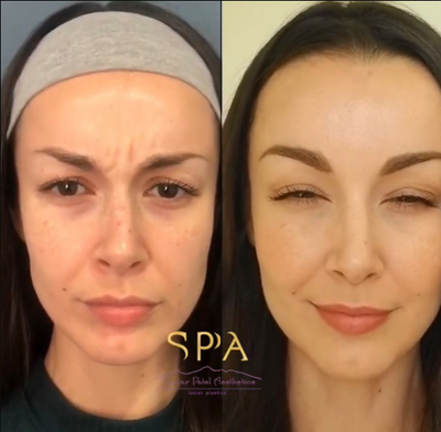 Botox before and after photo