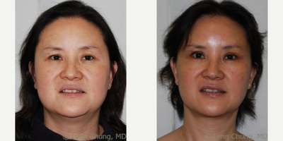 Eyelid Surgery before and after photo