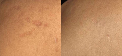 Fraxel Laser before and after photo