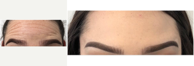 Botox before and after photo