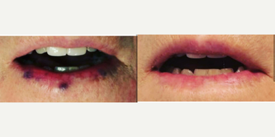 Excel V before and after photo