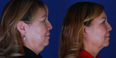 Kybella before and after photo