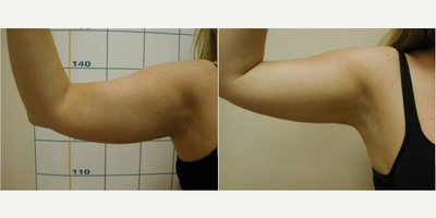 Liposuction before and after photo
