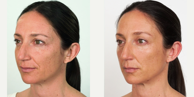 Restylane before and after photo