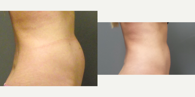 CoolSculpting before and after photo