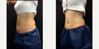 Emsculpt before and after photo