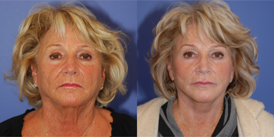 Facelift before and after photo