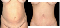 Liposculpture before and after photo