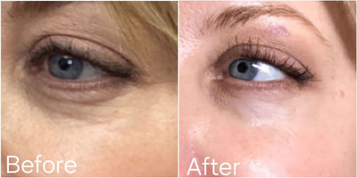 Microneedling RF before and after photo