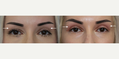 Botox before and after photo