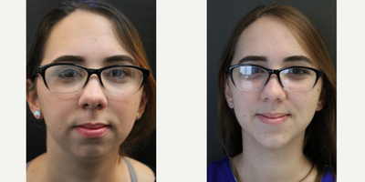 Chin Implant before and after photo