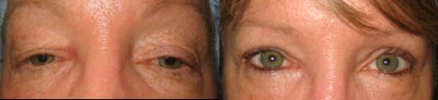 Eyelid Surgery before and after photo