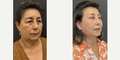 Eyelid Surgery before and after photo