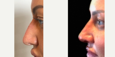 Nonsurgical Nose Job before and after photo