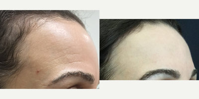 Pelleve before and after photo