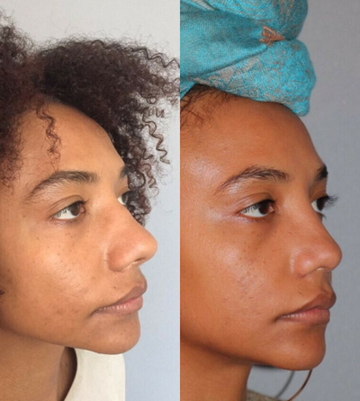 Rhinoplasty before and after photo