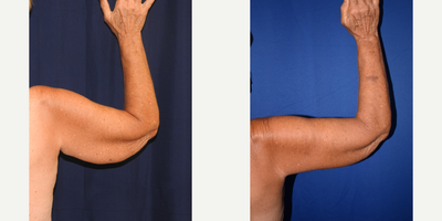 Arm Lift before and after photo