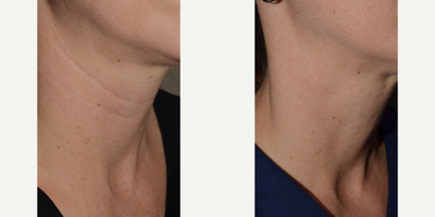 Belotero before and after photo