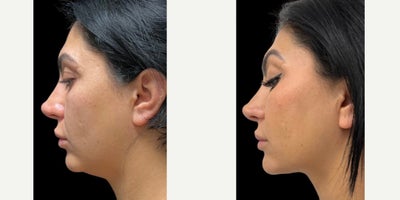Chin Liposuction before and after photo